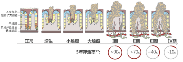肠癌病变过程.png
