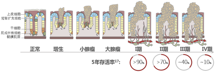 肠癌病变过程.png