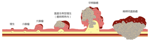 肠癌演变图.png